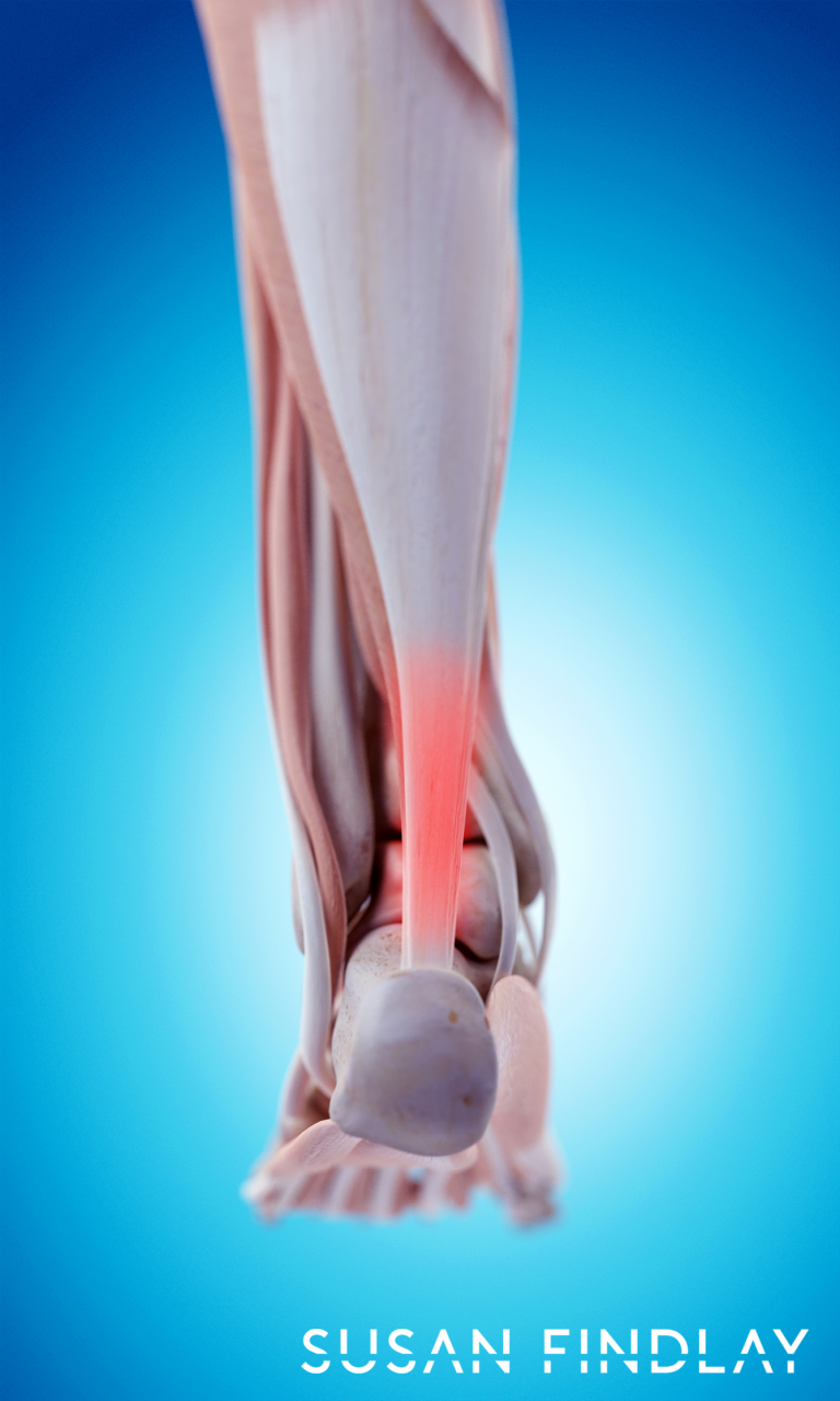 The Use Of Massage Therapy For Tendinitis/ Tendinopathy - Susan Findlay